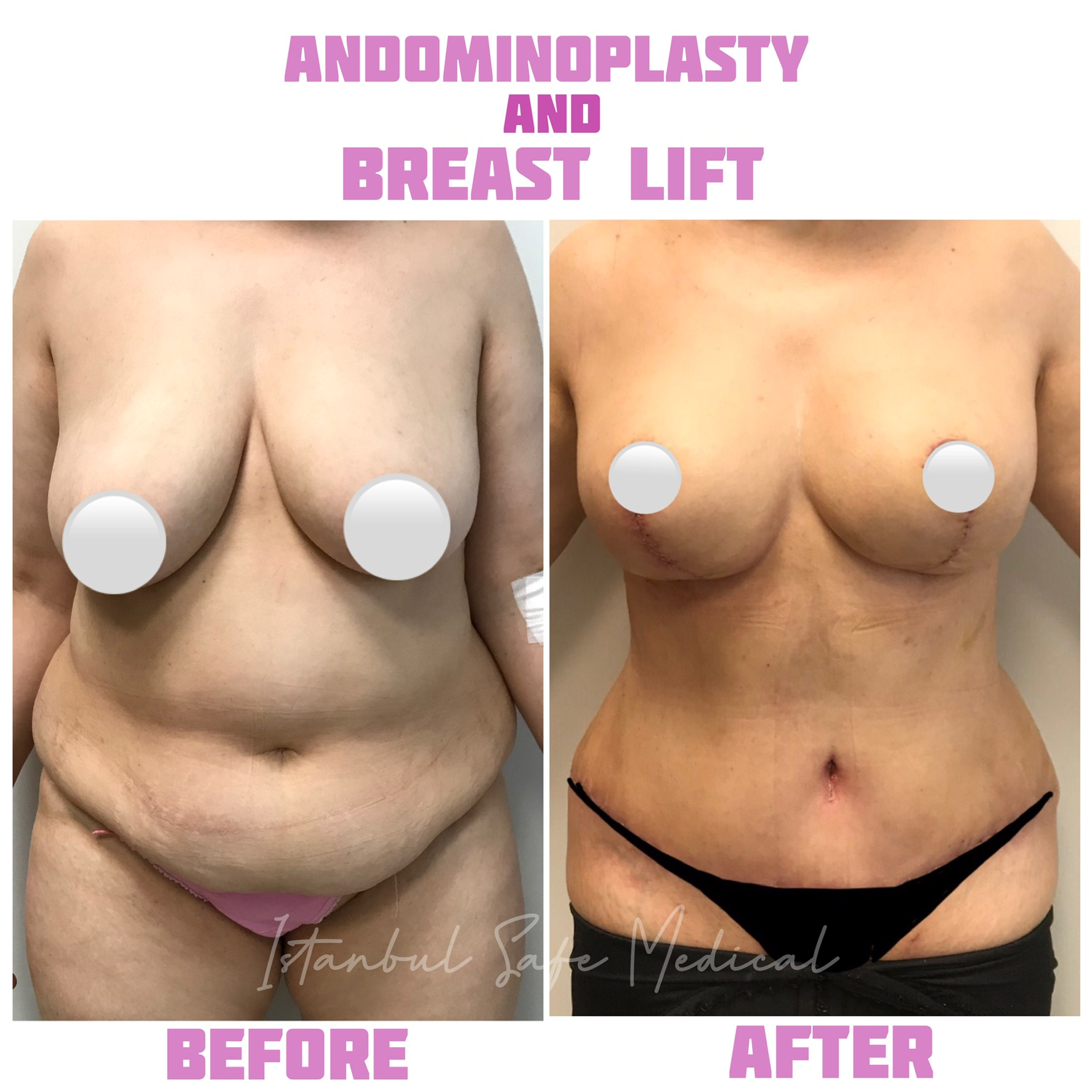 abdominoplasty-breast-lift-2