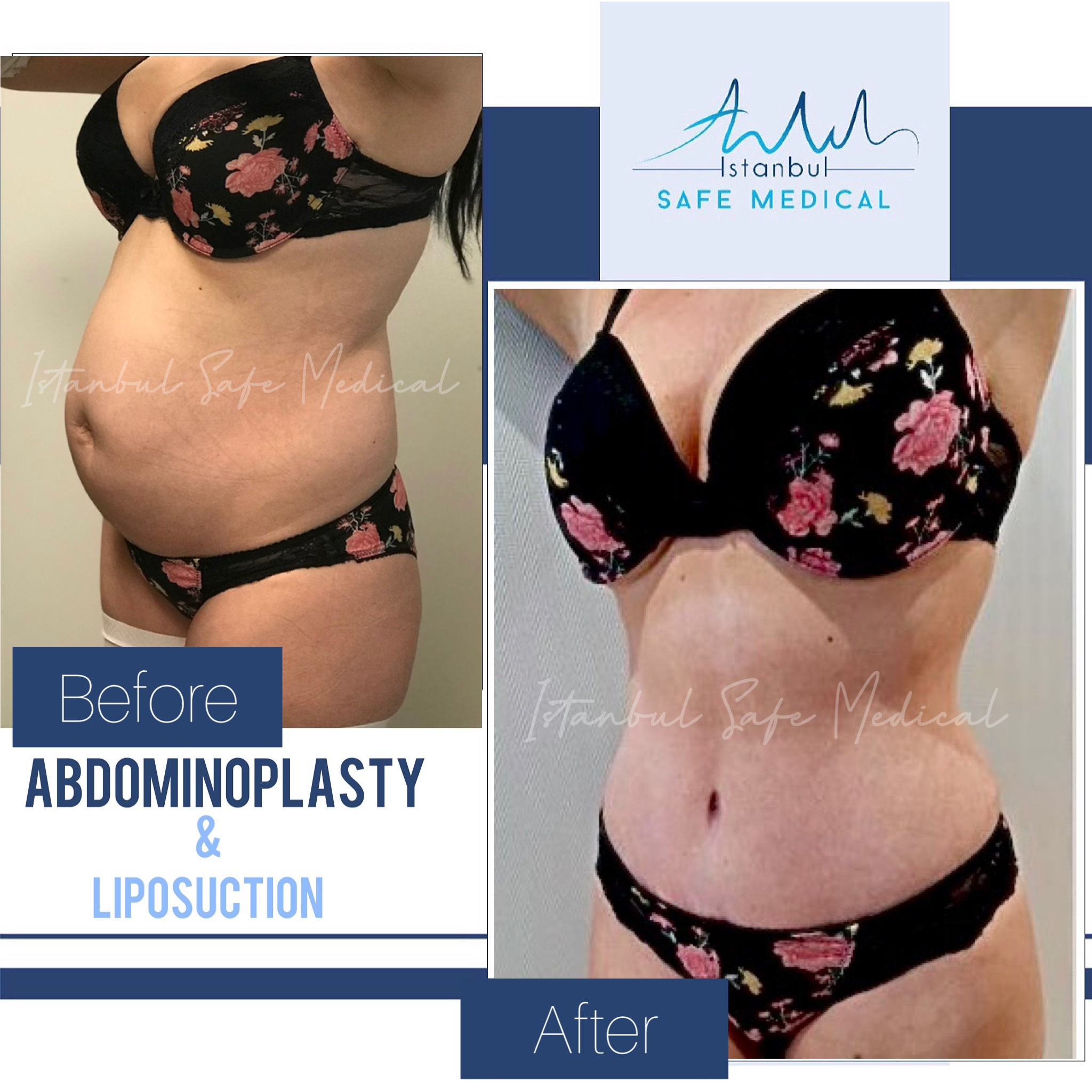 Cosmetic surgery Turkey