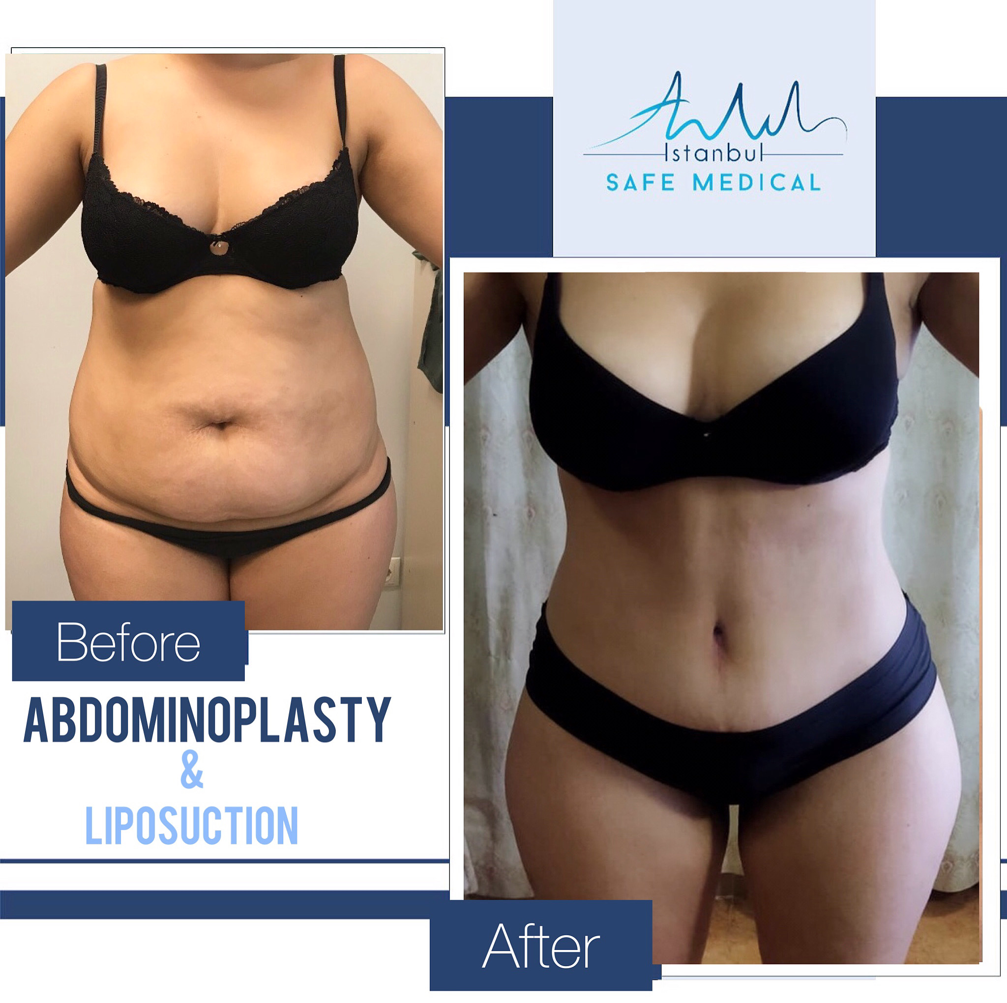 Cosmetic surgery Turkey
