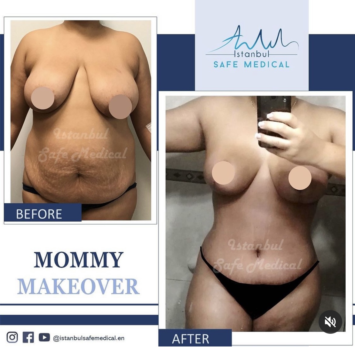 Cosmetic surgery Turkey
