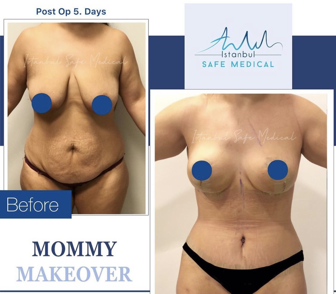 Cosmetic surgery Turkey