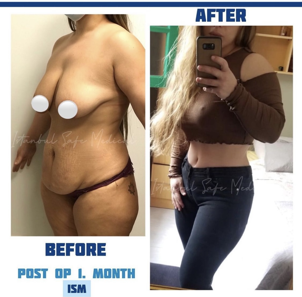 Cosmetic surgery Turkey